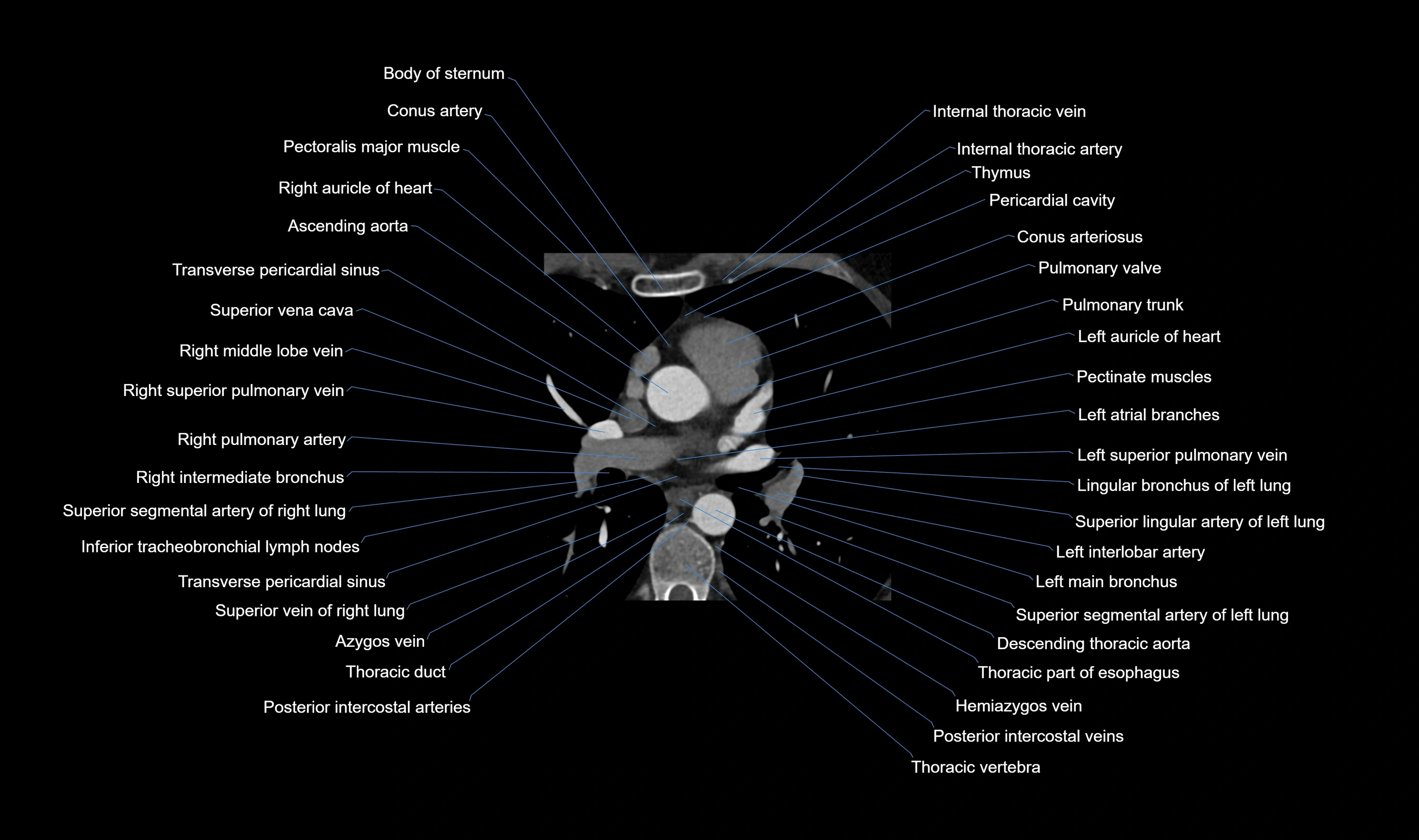 CT heart (coronary angiogram) axial view cross sectional anatomy labelled radiology image-00019.webp